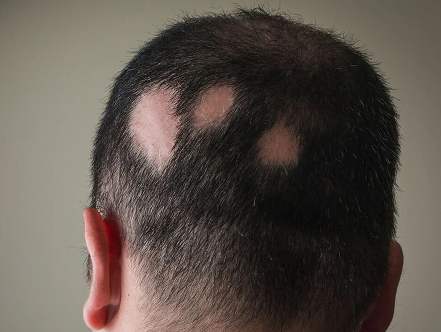 Alopecia treatment results at ryan